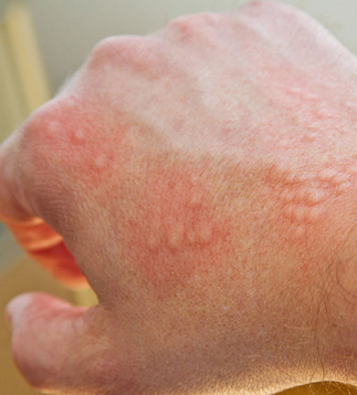 Alergická reakce na avenin obsažený v ovesných vločkách